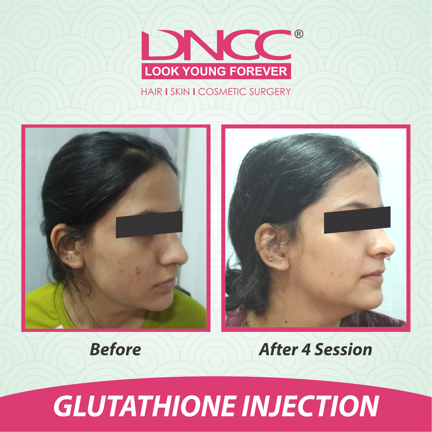 Hair Transplant Transformation 1